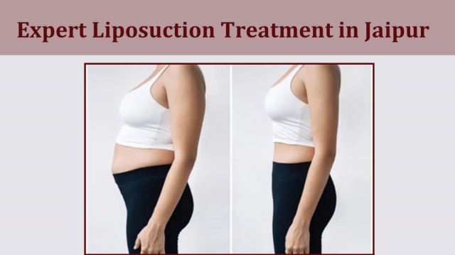 Expert Liposuction Treatment in Jaipur