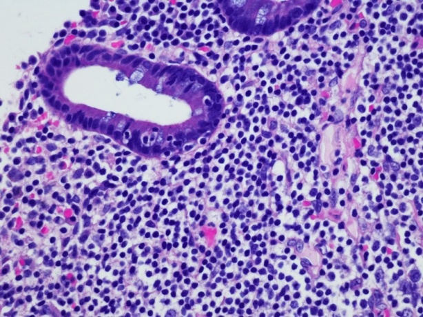 Advancements in Hodgkin's Lymphoma Treatment