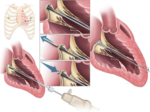 Mitral Valve Devices Industry is Estimated to Witness Significant Growth Owing to Growing Prevalence of Mitral Valve Diseases 