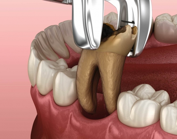 Gentle and Efficient Tooth Extractions by Dubai’s Experts