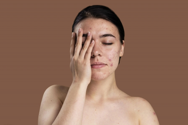 Say Goodbye to Acne Scars with Microneedling Treatment in Islamabad