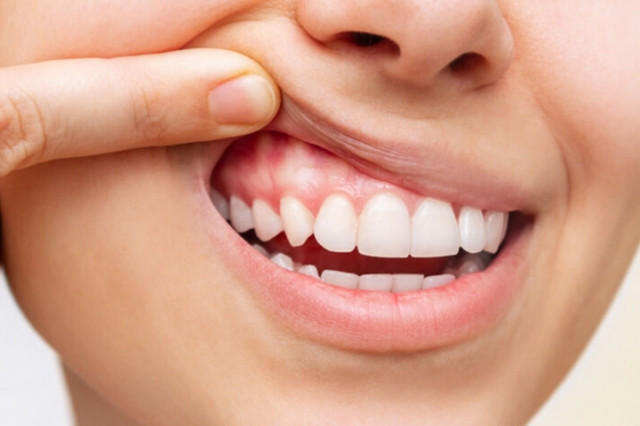 Perfect Your Smile with Professional Gum Depigmentation in Dubai