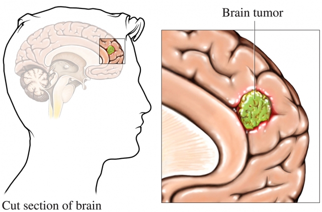 Are Brain Tumors Visible from the Outside?