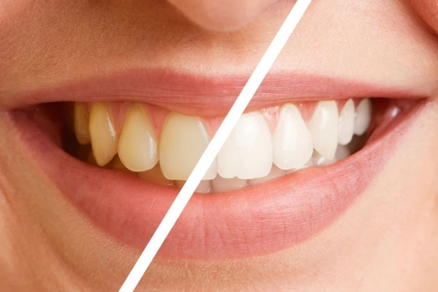 Maintaining a Brilliant Smile After Teeth Whitening