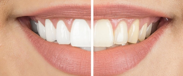 The Best Teeth Whitening Treatments in Dubai for Instant Results