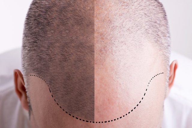 Best Hair Transplant Treatment