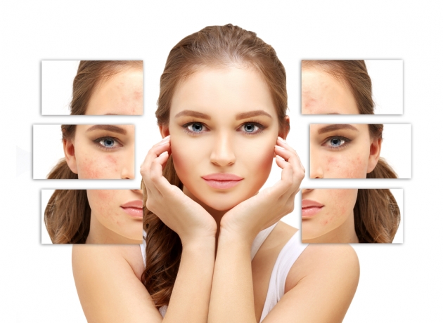Best Acne Scar Treatment