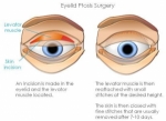 Ptosis Market Size, Share, Trends, Industry Report 2024-34
