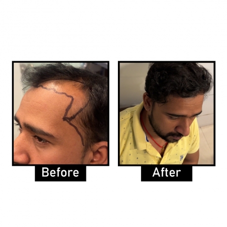 Hair Transplant in Delhi Expert Tips for Achieving Natural Results