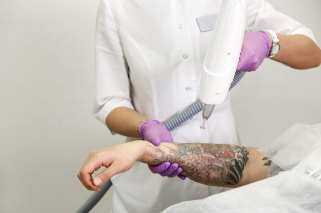 How Does Laser Tattoo Removal Work for Different Tattoo Sizes in Dubai?