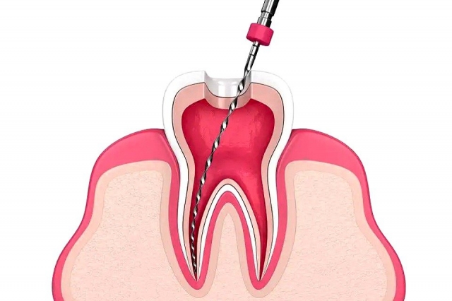 Posterior Root Canal Treatment by Skilled Dubai Dentists