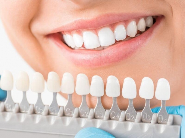 Your First Veneer Appointment: What You Need to Know