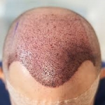 Look and Feel Younger with Hair Transplants in Riyadh