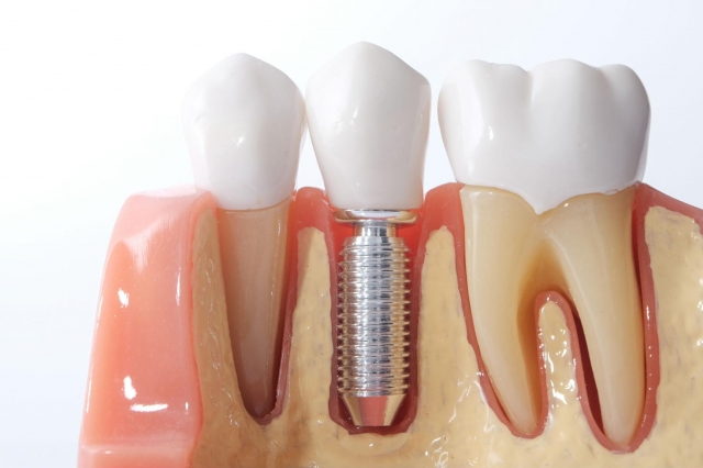 Revolutionizing Dental Care with Same-Day Implants