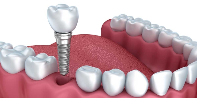 Dental Implants Can Improve Your Quality of Life