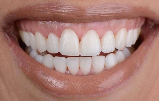 How Gum Contouring Enhances Facial Harmony