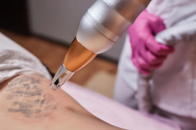 How Long Does Tattoo Removal Take? Insights from London Clinics