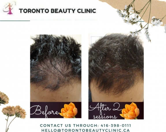 Crucial Things To Know About Post hair transplant PRP treatment!