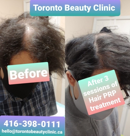 Did Your Hair Transplant Fail- Post Hair Transplant PRP Treatment Might Be The Answer