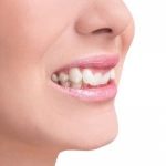 How can I maintain my results after crooked teeth treatment in Dubai?
