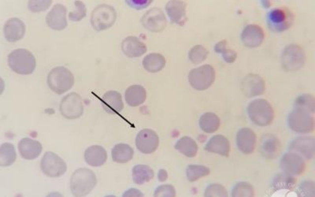 The Future of Gene Therapy for Thalassemia Major in India