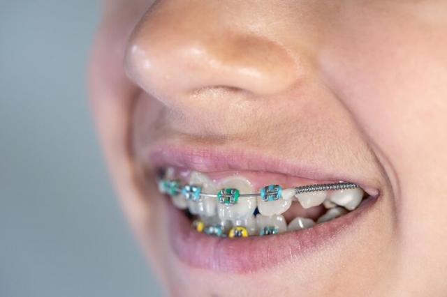 Braces in Birmingham: What Are Your Options?