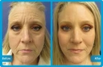 Face Lift Turkey: Why It’s the Ideal Destination for Affordable and High-Quality Surgery