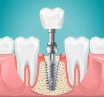 Fast-Track Your Smile with Same-Day Dental Implants