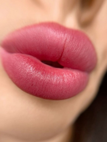 Get Stunning Lips with Russian Lip Fillers in Dubai