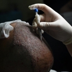 How to Prepare for Your Hair Transplant Procedure in Islamabad