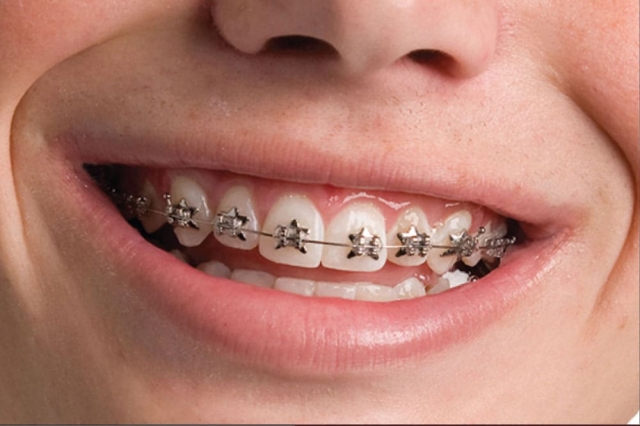 How Dental Braces Can Improve Your Oral Health