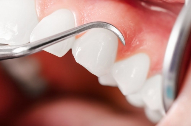 Take Control of Your Gum Health with Gingivectomy