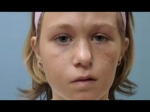 Parry Romberg Syndrome Market Set to Grow at a CAGR of 5% Owing to Advancements in Gene Therapy