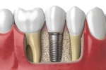 Preventing Infection After Dental Implant Surgery