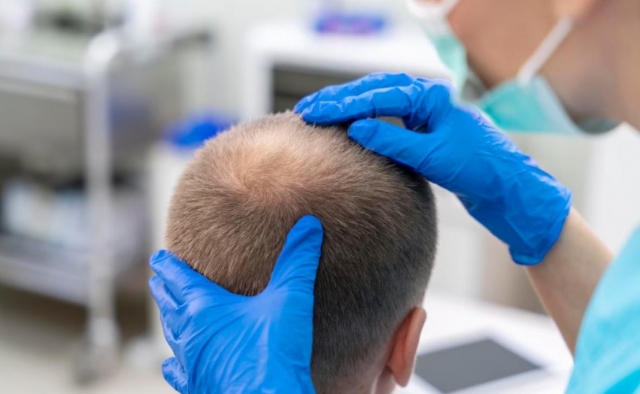 Cheapest Hair Transplant Treatment