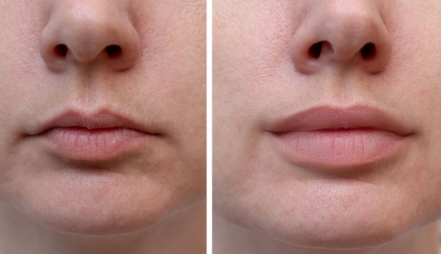 Lip Filler and Mesotherapy in Delhi