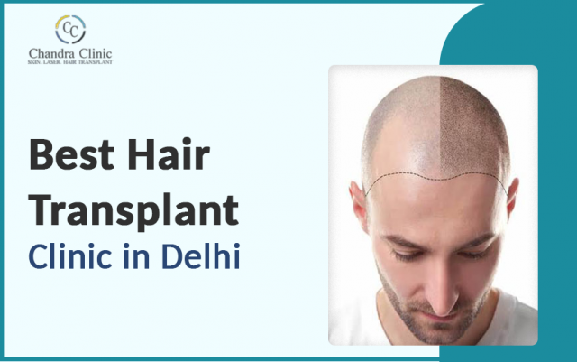 What’s the Average Cost of Hair Transplant Surgery in 2025?