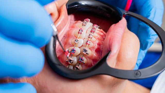 How Clear Aligners Are Revolutionizing the Way We Straighten Teeth 