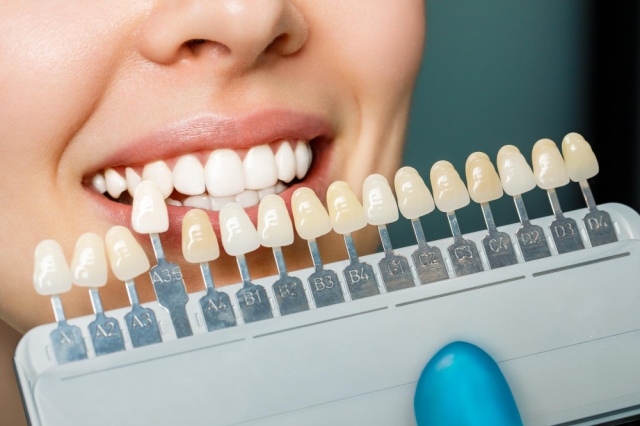 The Secret to Long-Lasting Veneers: Tips and Tricks