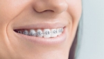 A Beginner’s Guide to Metal Braces