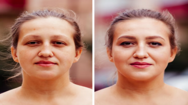 Smooth, Spotless Skin Awaits You: Mole Removal Services in Norwich by Estetika Clinic