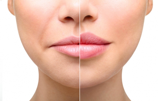 Benefits of Hyaluronic Acid Fillers for Lip Augmentation in Islamabad