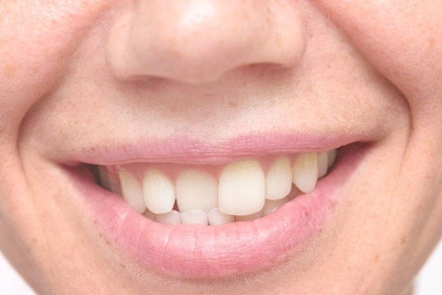 The Science Behind Treating Overlapping Teeth