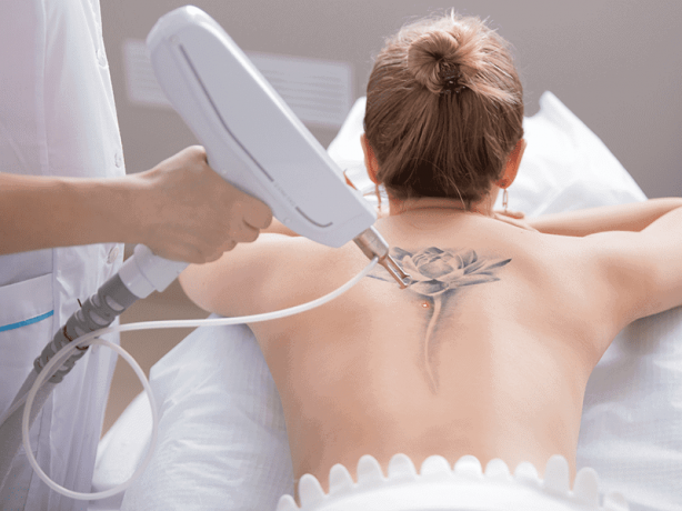 Tattoo Removal in Bristol: 5 Steps to a Clean Slate