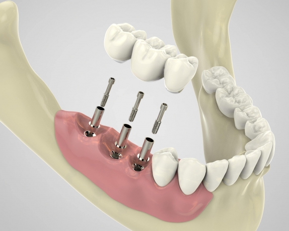 Step-by-Step Process of Getting Dental Implants