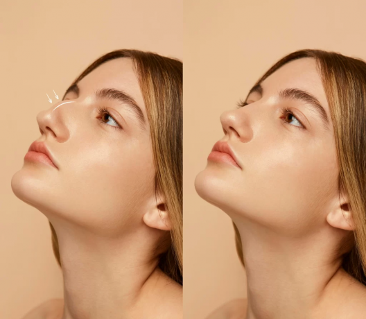 What You Should Know About a Bulbous Nose Job