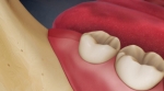 Tooth Extraction, Common Myths and Facts