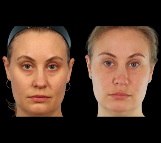 Achieve Radiance with Tear Trough Fillers by the Best Under Eye Fillers Doctors in Dubai