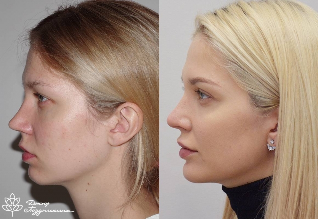 Best Septoplasty in Dubai | Trusted Surgeons