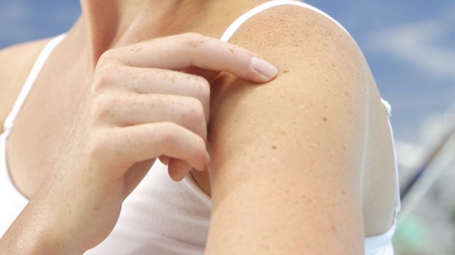 Lamellar Ichthyosis Market will grow at owing to increasing research and development activities